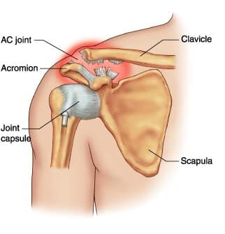 Acromioclavicular joint injury