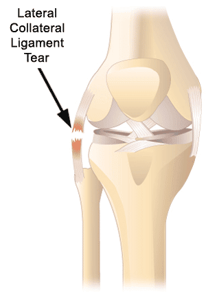 Lateral Collateral Ligament Injury