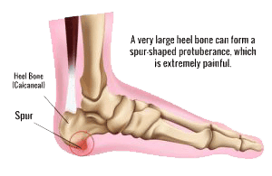 Heel Pain Treatment at Home | Ayurvedic Secrets | Brick Therapy | Doctor  Smrithi - YouTube