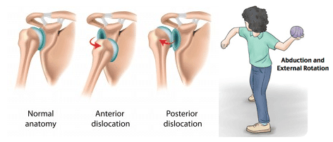 Shoulder dislocations