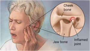 Temporomandibular Joint dysfunction
