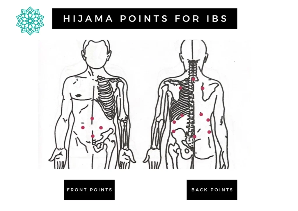 : A diagram illustrating "Hijama Points for IBS." It displays two figures: "Front Points" with red dots on the abdomen, and "Back Points" with red dots along the spine, shoulders, and lower back.