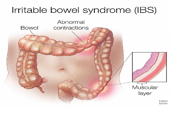 Hijama Irritable Bowel Syndrome