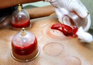 Types of Cupping