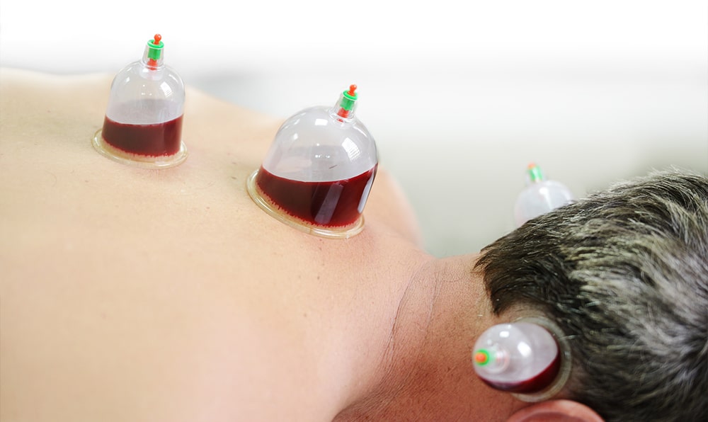Types of Cupping