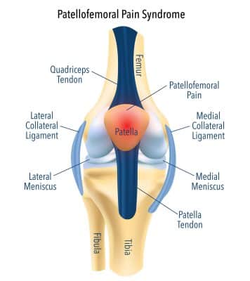 Knee Patellofemoral Joint Dysfunction