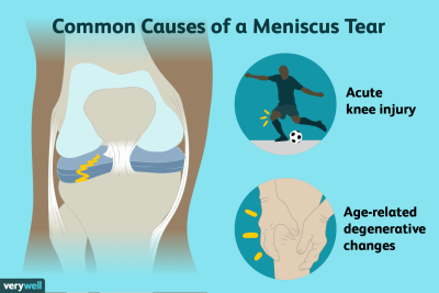 common causes of a meniscus tear
