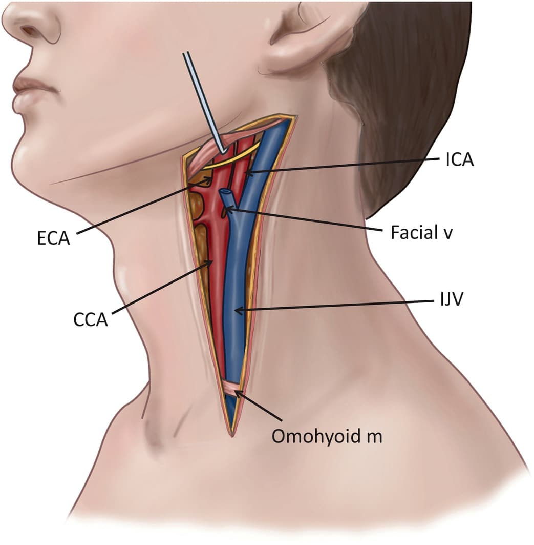 hijama wet cupping treatment