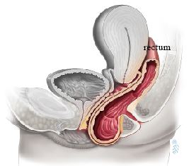 Bowel prolapse