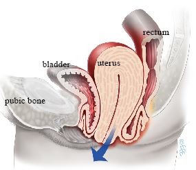 Uterus prolapse