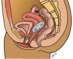 Medical illustration of a cross-section of the female pelvis showing a pessary device inserted to support pelvic organs.