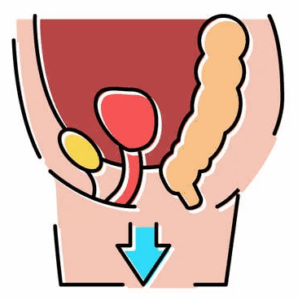 Medical illustration showing pelvic organ prolapse with organs descending and a blue arrow indicating downward movement.