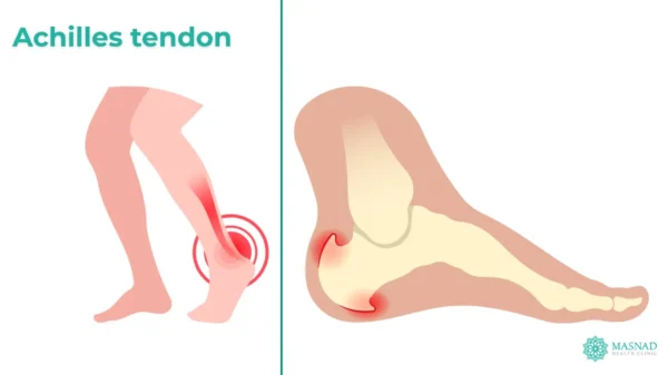 Anchiles Tendon