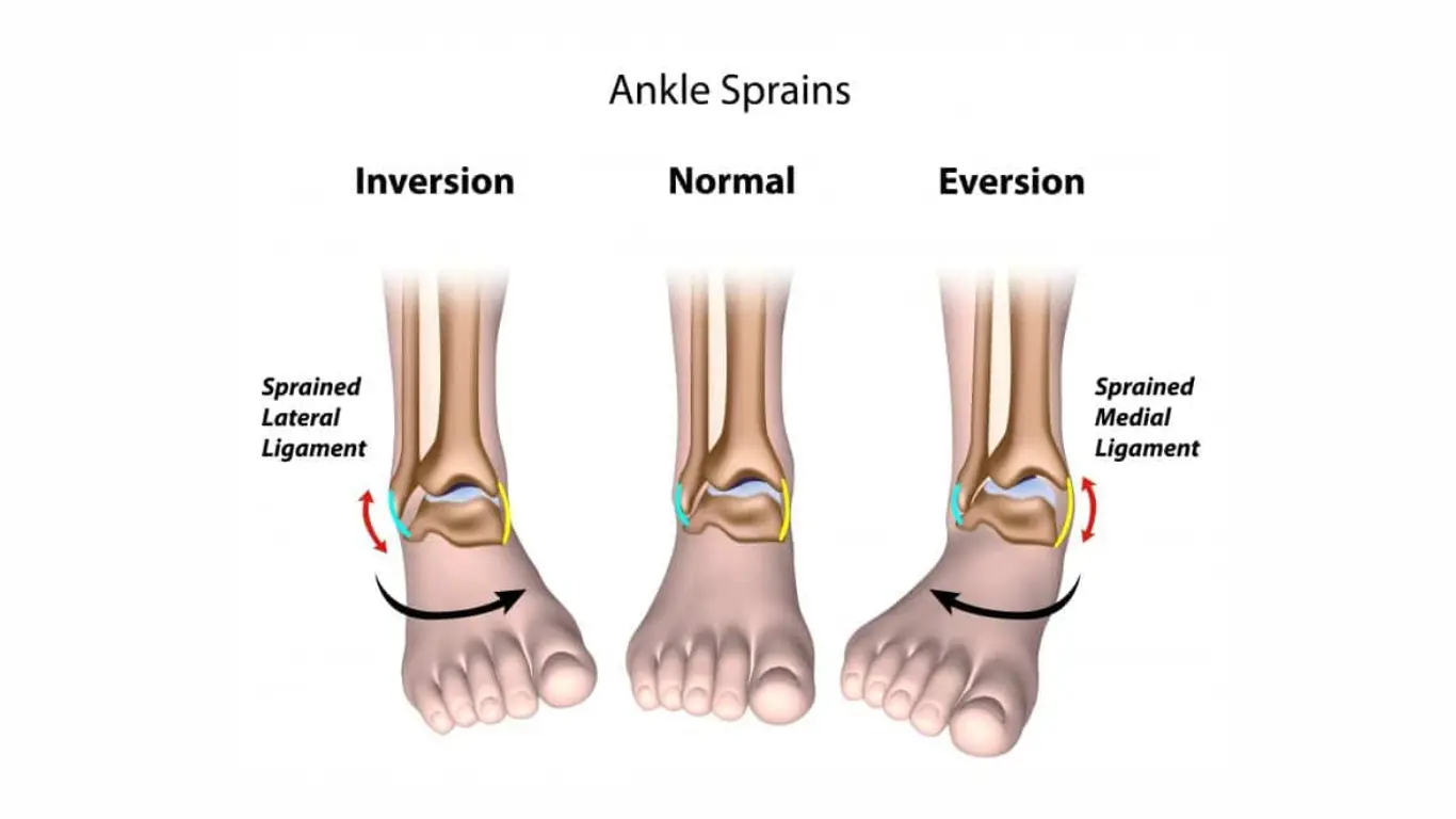 Ankle Instability