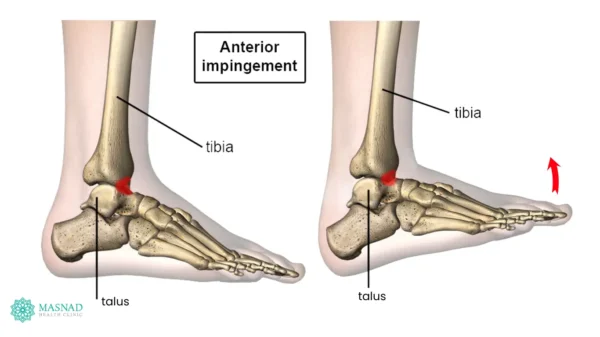 Diagram showing front ankle impingement area