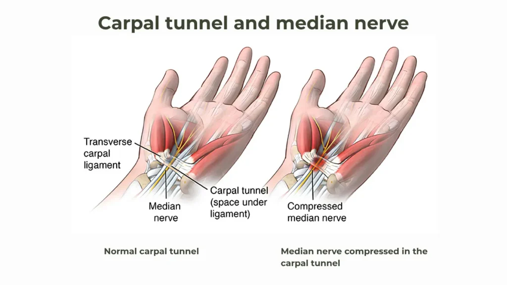 Carpal Tunnel Syndrome