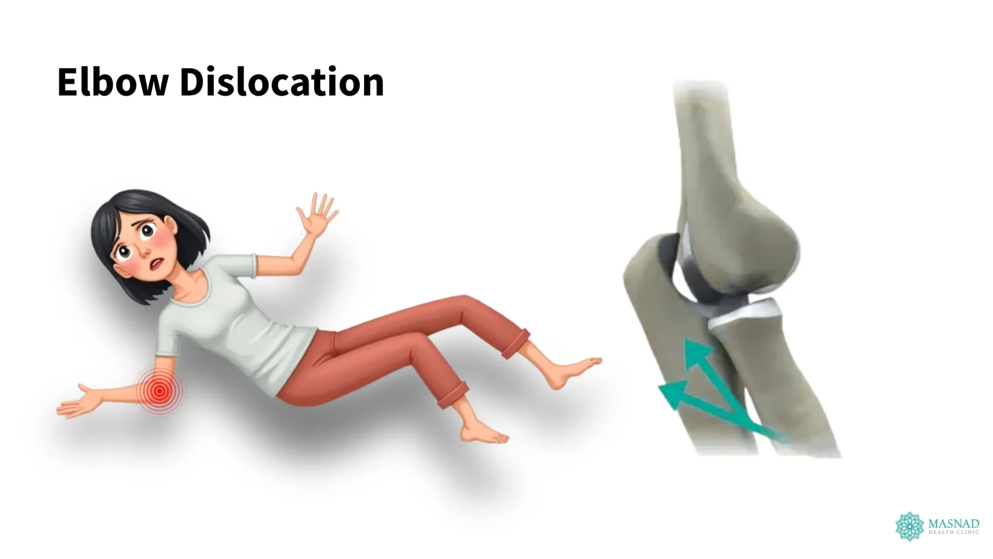 Elbow Dislocation
