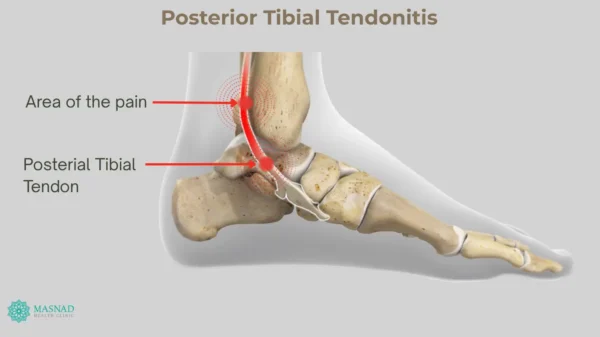 Posterior Tibial Tendonitis