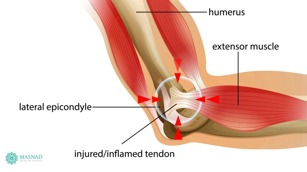 Tennis Elbow Diagram