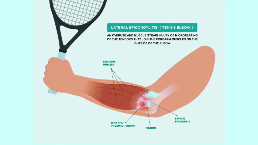 Tennis Elbow Diagram