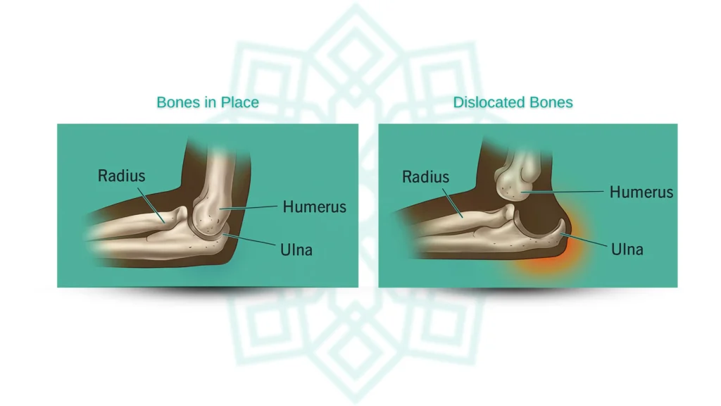 diagram of elbow bones and common dislocation