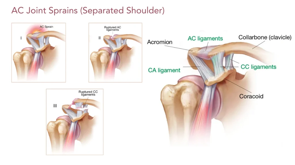AC Joint Sprains (Separated Shoulder)