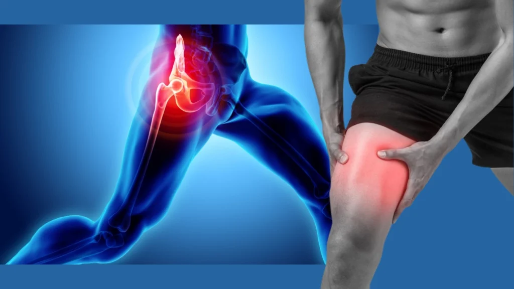 Adductor Tendinopathy