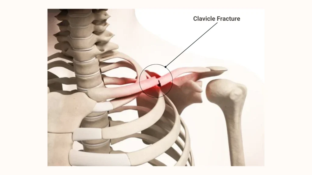 Clavicle Fracture