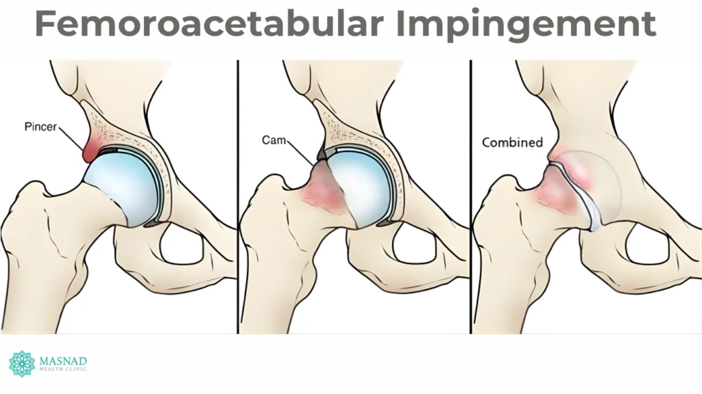 Femoroacetabular Impingement