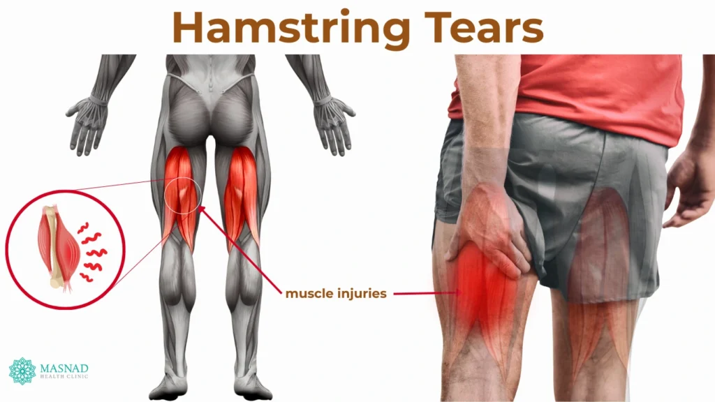 Hamstring Tears (1)