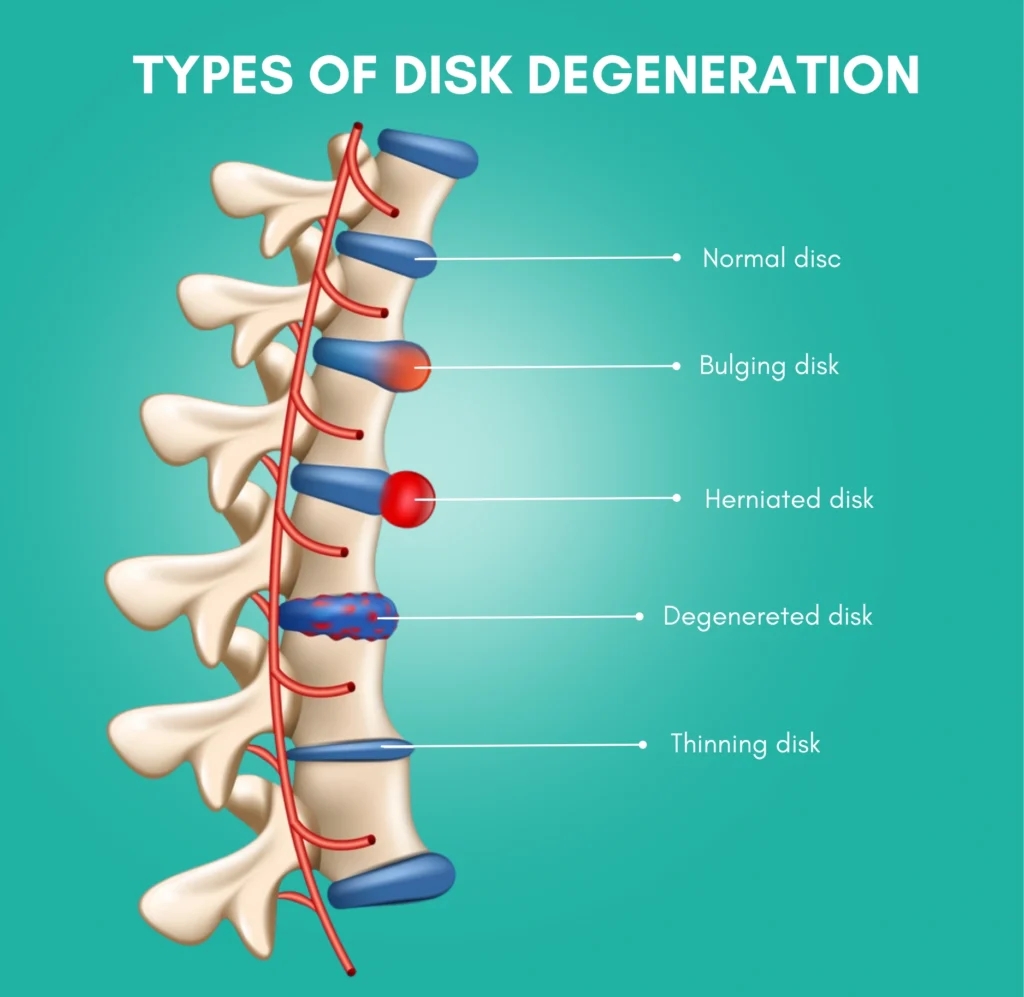 Lumbar Disc Degeneration