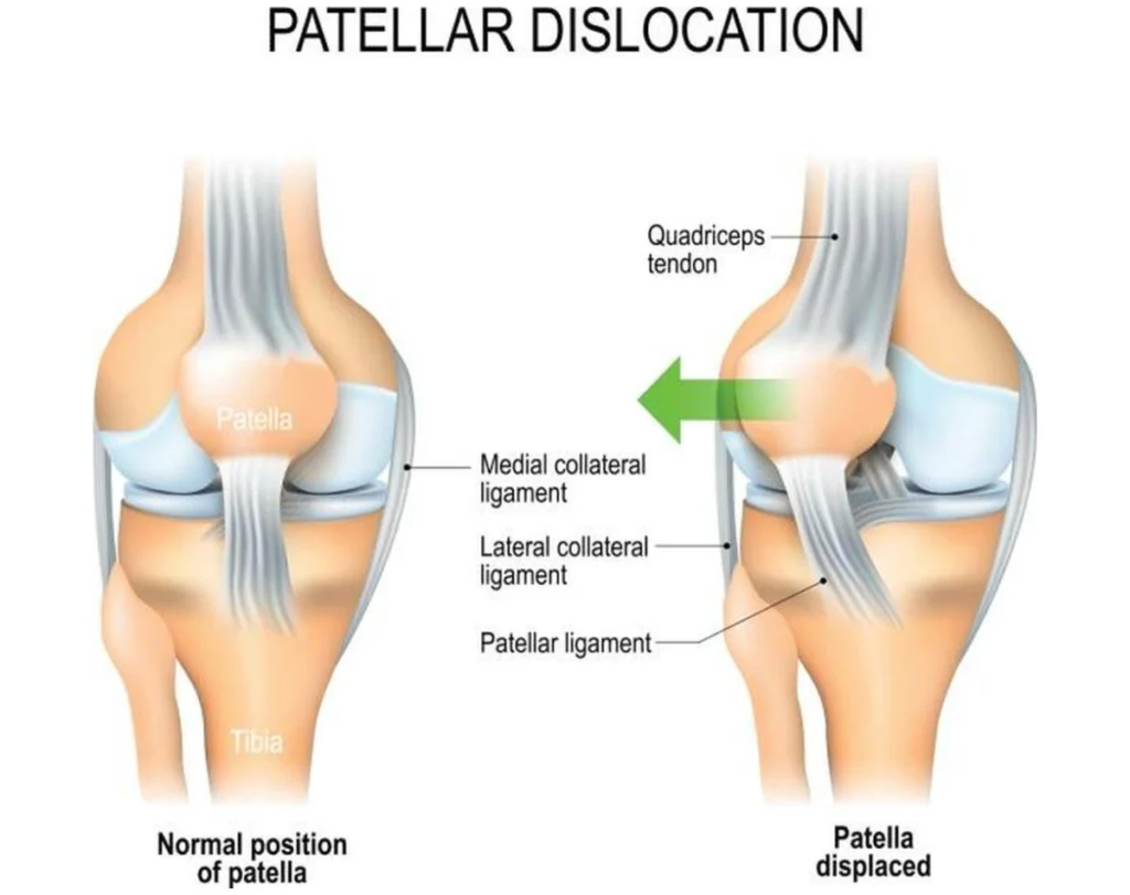 Patella Dislocation