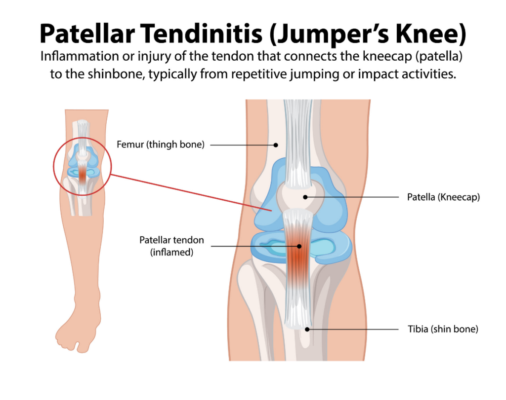 Patella Tendinopathy