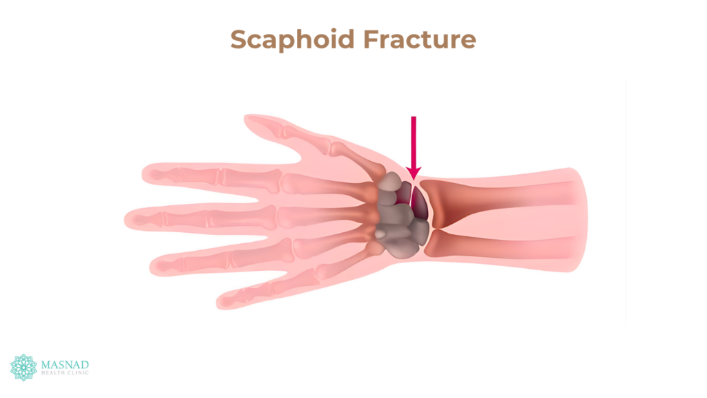 Scaphoid Fracture