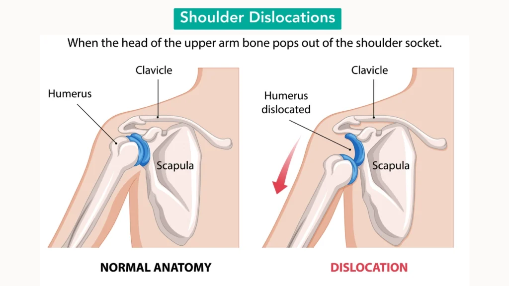 Shoulder Dislocations