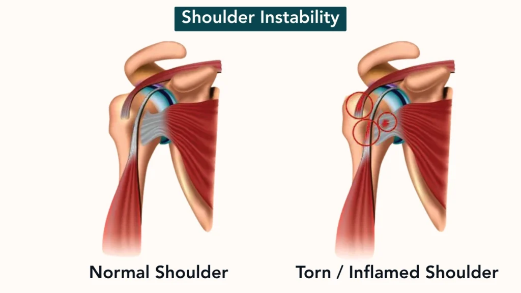 Shoulder Instability