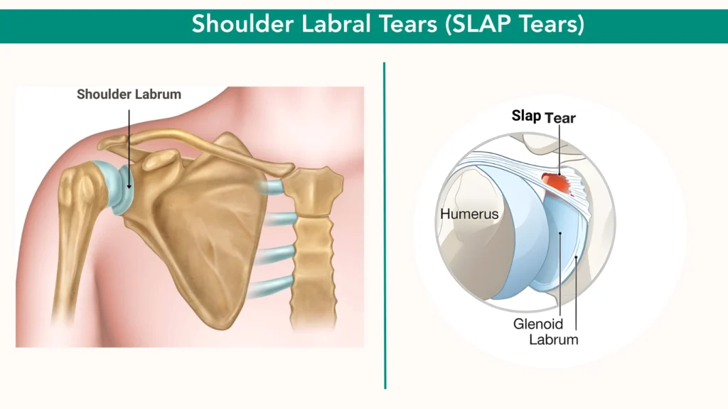 Shoulder Labral Tears (SLAP Tears)