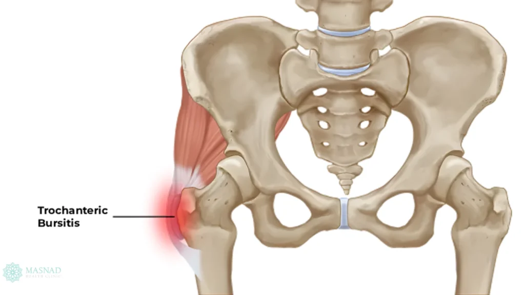 Trochanteric Bursitis
