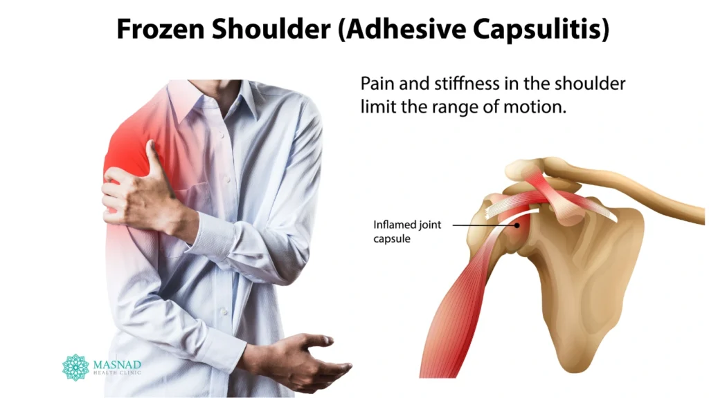frozen shoulder