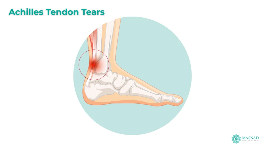 Achilles Tendon Tears