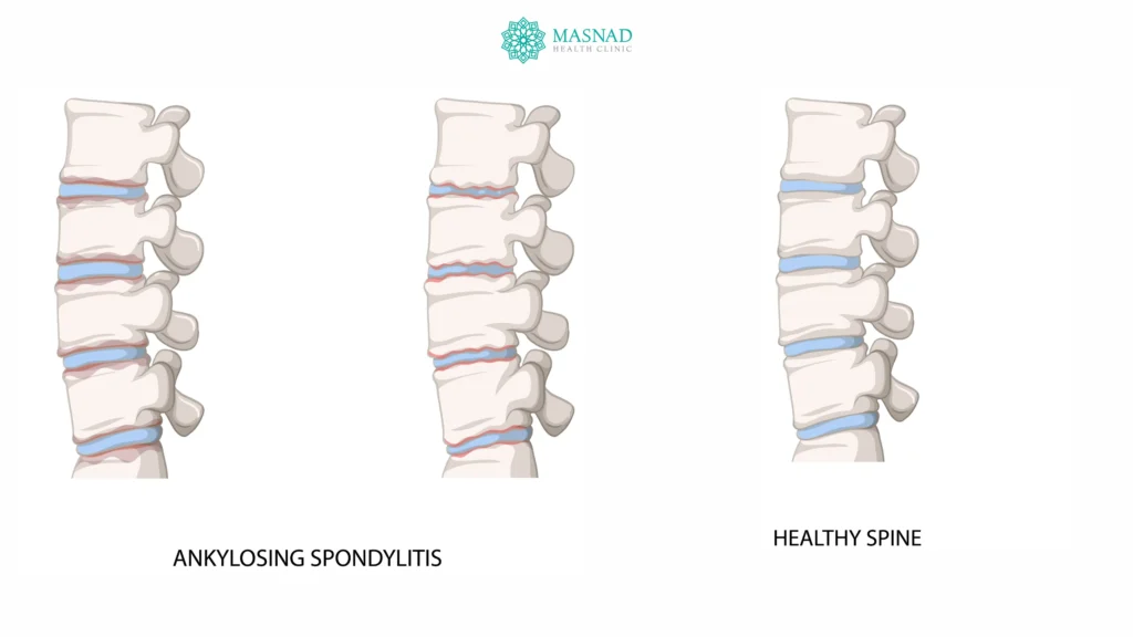 Ankylosing Spondylitis