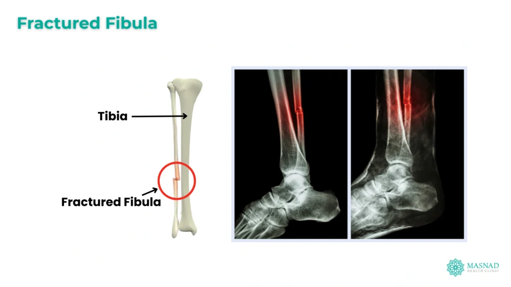 Fibula Fractures