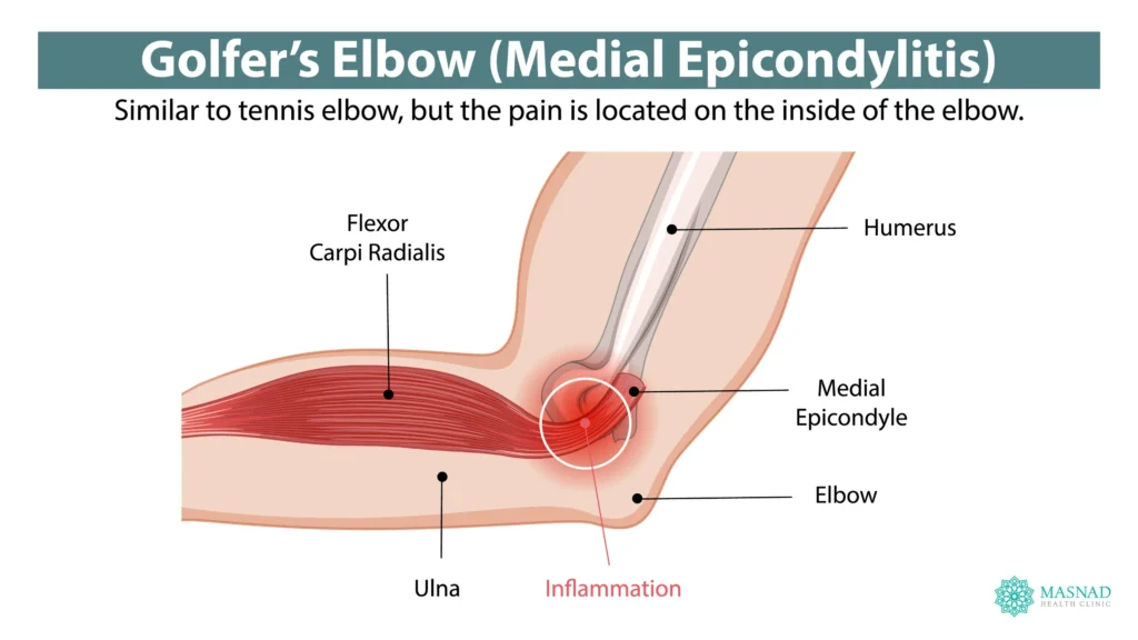 Golfers Elbow