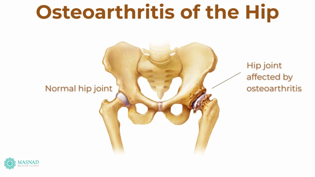 Osteoarthritis of the Hip (1)