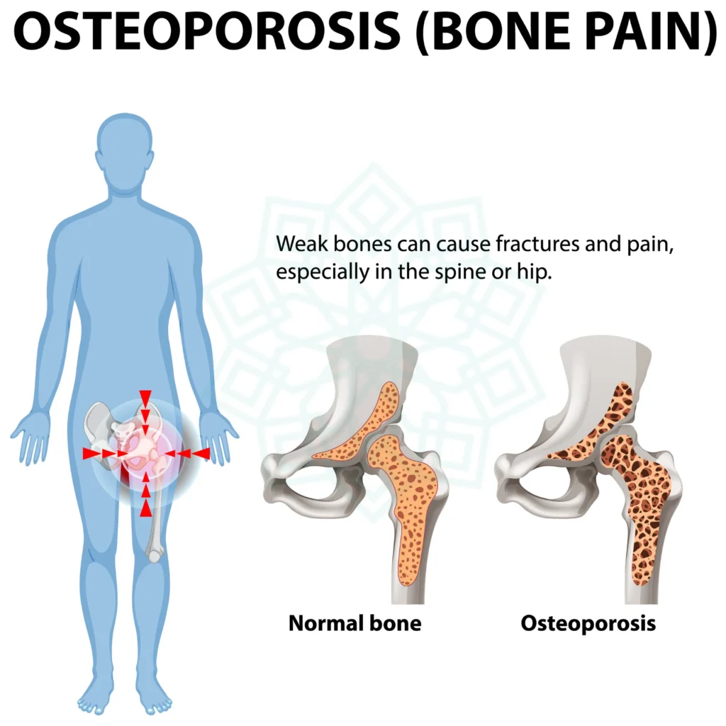 Osteoporosis