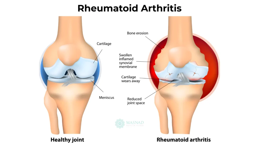 Rheumatoid Arthritis