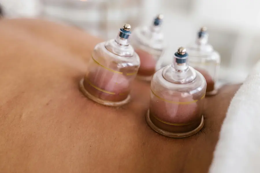 Close-up of hijama (wet cupping) therapy being performed at Masnad Health Clinic to support pain relief, circulation, and recovery.