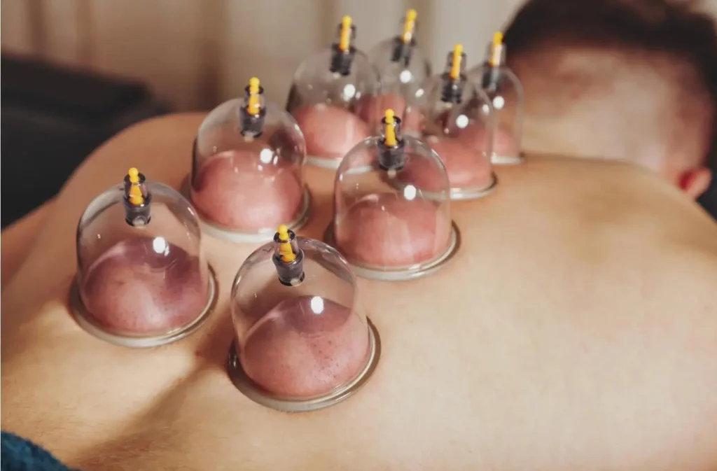 Patient undergoing wet cupping to support muscle recovery, pain relief, and improved circulation at Masnad Health Clinic.